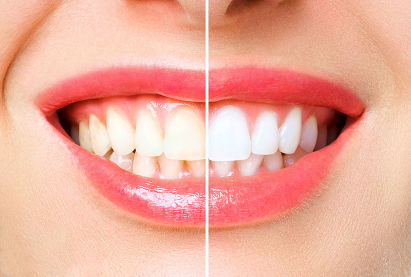 Teeth Whitening in Bayswater 1 Close-up of teeth showing early yellowing, one of the common causes of yellow teeth from coffee and wine
