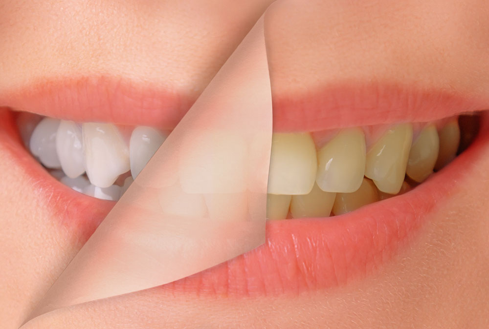 Teeth Whitening in Bayswater 6 Why Choose Aura Dentists for Your Teeth Whitening